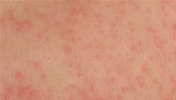 Light baby eczema rash